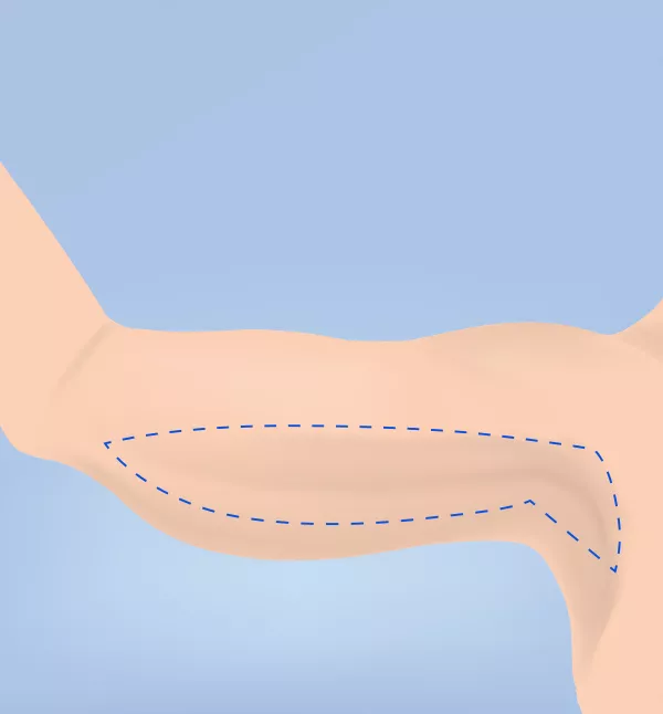 Brachioplasty Performed Way