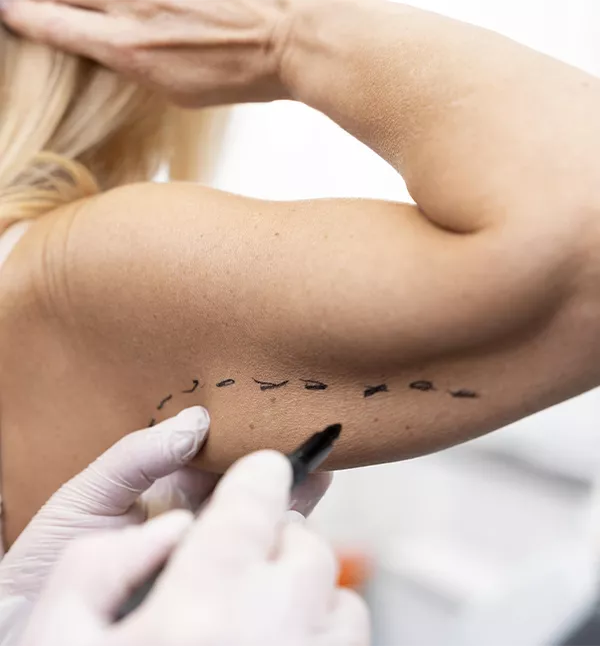 Brachioplasty Arm Lift